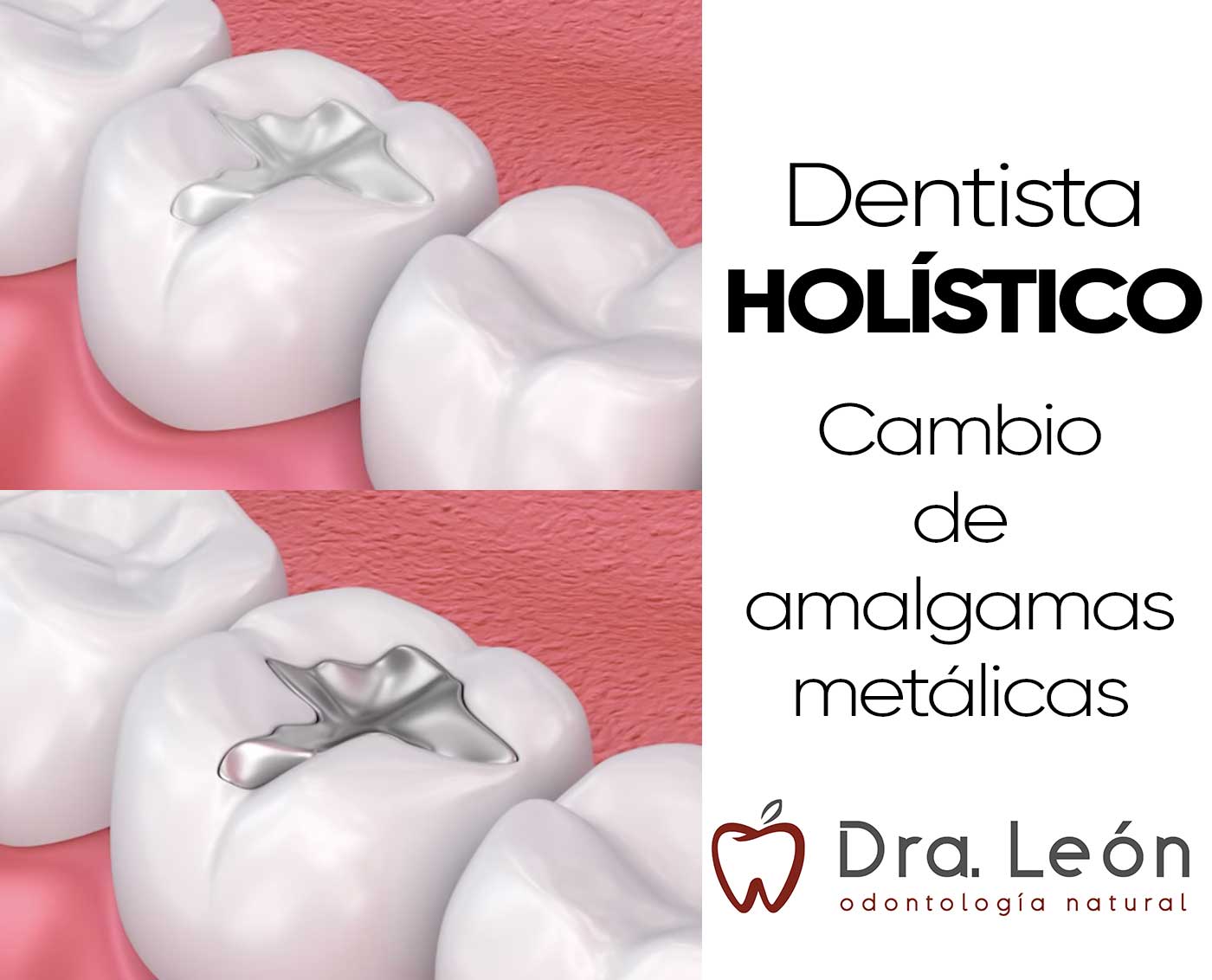 dentista holístico Madrid cambio de amalgamas y empastes de metal mercurio