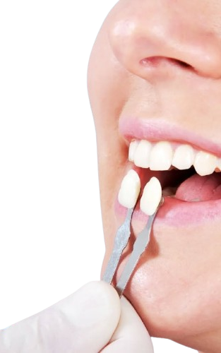 tratamiento de carillas dentales en Madrid