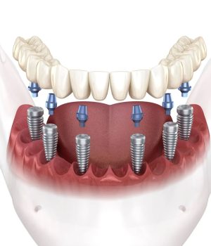protesis-fija-sobre-implantes